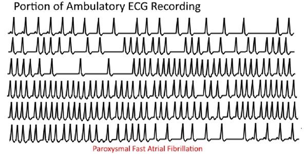 Ambulatory ECG