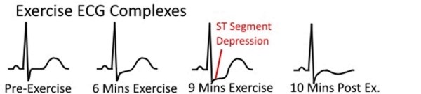 Exercise ECG