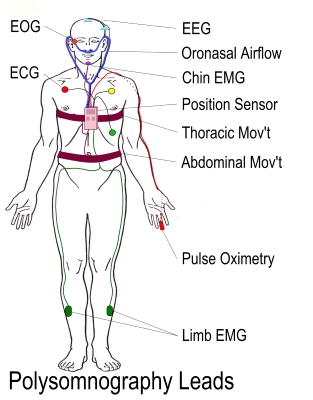 Polysomnography Leads