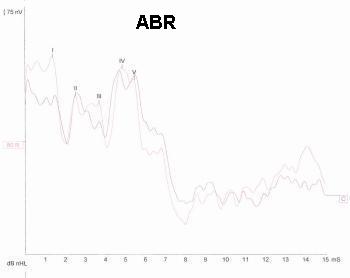 ABR