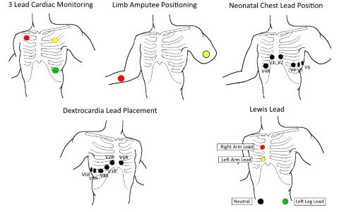 Alternative Leads