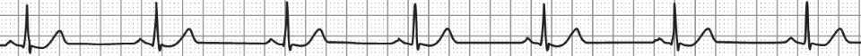 ECG Strip