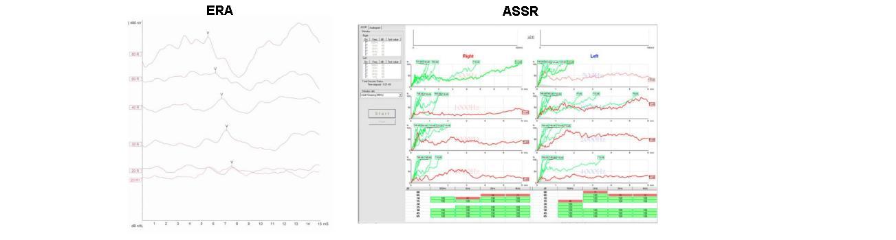 ERA and ASSR