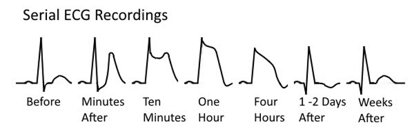 Serial ECG