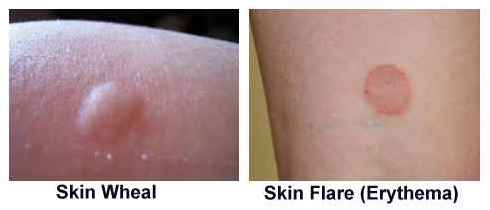 Skin Rash Type