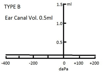 Type B Low Tympanogram