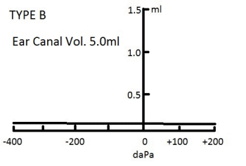 Type B High Tympanogram